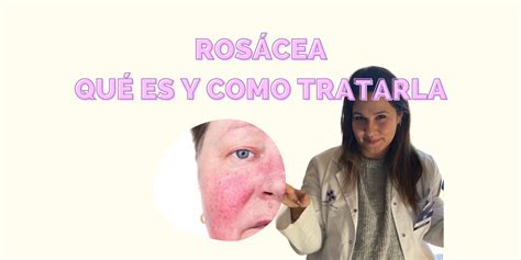 ¿qué Es La Rosácea Y Cómo Tratarla ¡te Ayudamos