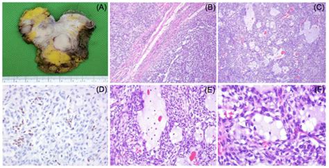 Proximal Type Epithelioid Sarcoma Of The Vulva Initially Misdiagnosed