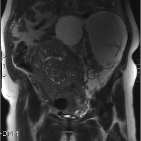 Pelvic Mri Showing A Huge Uterine Mass And A Left Adnexal Complex Cyst Download Scientific