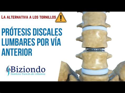 Descubre las mejores prótesis de disco lumbar según las opiniones de