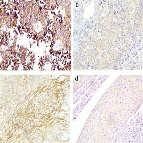 Representative Immunohistochemical Staining Of E Cadherin In Tccs And