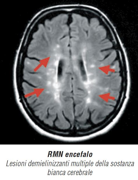 La Sclerosi Multipla Diagnosi E Terapie A Milano Mondino Health Center