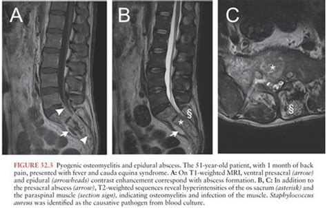 Epidural Abscess | Oncohema Key