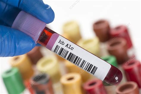 Haemoglobin A1c Blood Test Tube Stock Image F035 9209 Science