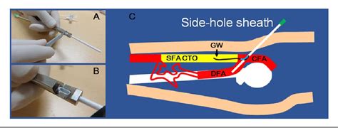 Figure From Transvenous Intravascular Ultrasoundguided Endovascular