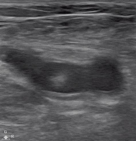 Lung Ultrasound Made Easy Step By Step Guide Pocus Academy