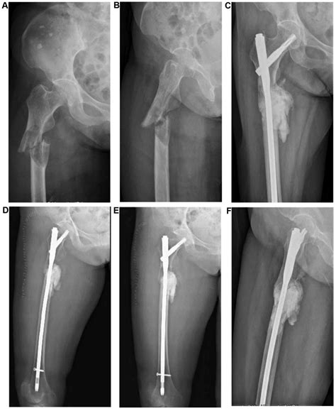 Intramedullary Nailing Femur Recovery Nail Ftempo