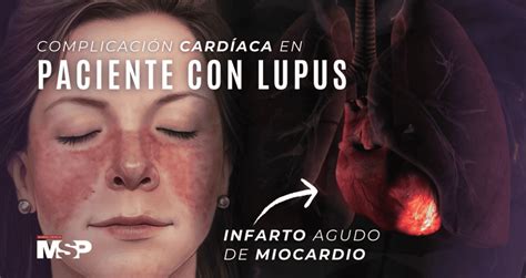 Complicación cardíaca en paciente con lupus infarto agudo de miocardio