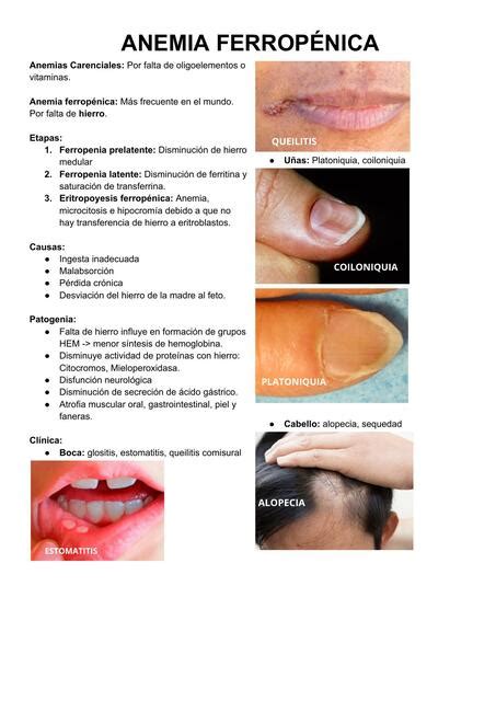 Anemia Ferrop Nica Rodrigo Marcelo Valladares Rivera Udocz