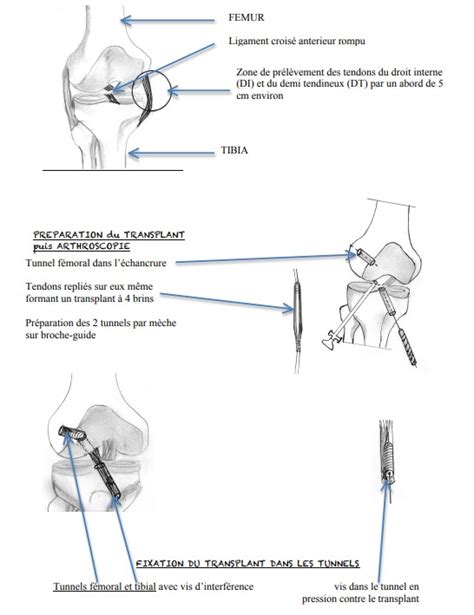 Ligamentoplastie Du Ligament Crois Ant Rieur Par Didt Docteur Martin