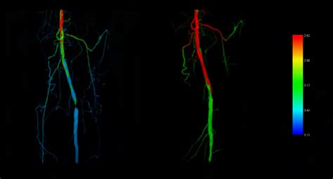 Advanced Visualization Of An Entire DSA Sequence IFlow Colour Coded