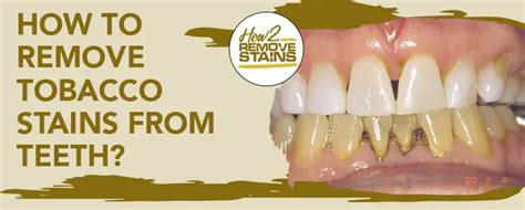 How To Remove Tobacco Stains From Teeth Detailed Answer