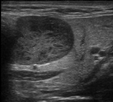 Ranula Ultrasound