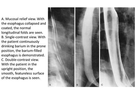 Barium Swallowpptx