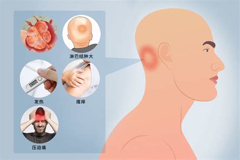 枕后淋巴癌早期症状图39健康网精编内容