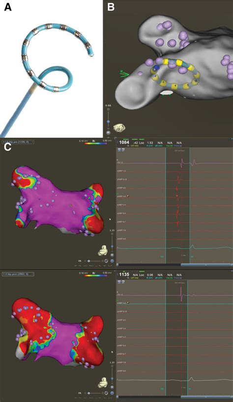 Paroxysmal Atrial Fibrillation Ablation Using A Novel Variable Loop