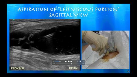 Ultrasound Guided Complictated Popliteal Cyst Aspiration Youtube