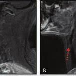 A Sagittal T Weighted Postcontrast Magnetic Resonance Imagings Of