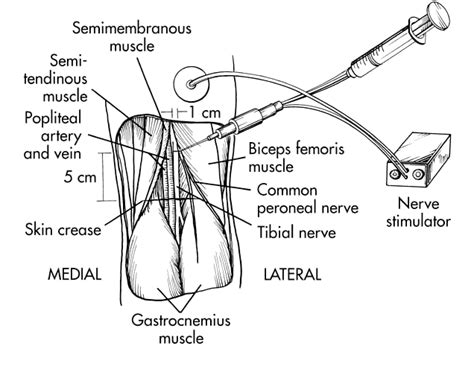 Figure 3 From Popliteal And Saphenous Nerve Blocks Semantic Scholar