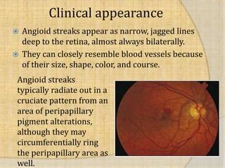 Angioid streaks | PPT