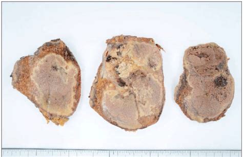 Macroscopic Findings Of The Resected Specimen The Tumor At Segment 6