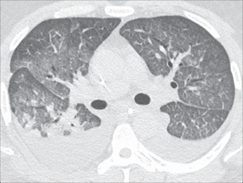 Scielo Brasil High Resolution Computed Tomography Findings In Eight