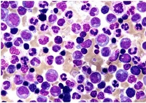 Hematologia Clínica LEUCEMIA MIELOIDE CRÔNICA LMC