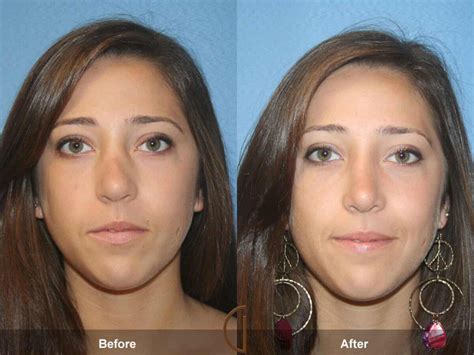 Female Rhinoplasty Before After Photos Patient Dr Kevin Sadati