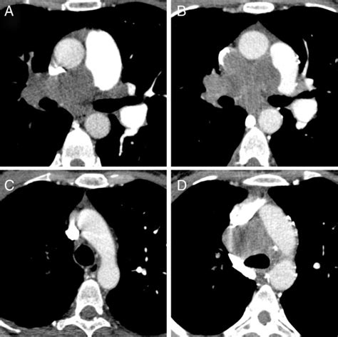 Ct Pulmonary Angiography Ctpa Of A 49 Year Old Female Patient With A