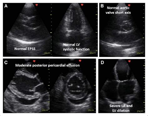 Echocardiogram Heart Ultrasound Vs