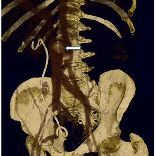 The Ct Scan At Month Follow Up After Vascular Plug Implantation