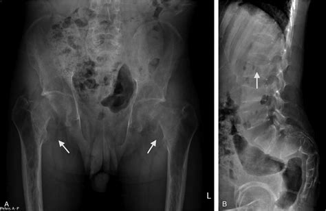 A Plain Radiograph Of The Pelvis Reveals Severe Osteoporosis And The Download Scientific