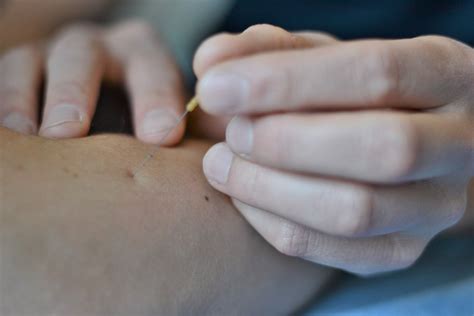 Dry Needling Fysiotherapie Castelijns