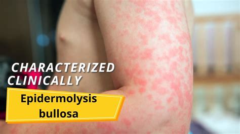 Epidermolysis Bullosa Symptoms And Causes Youtube