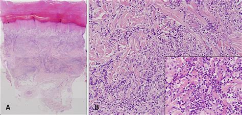 Palisaded Neutrophilic Granulomatous Dermatitis In A Patient With