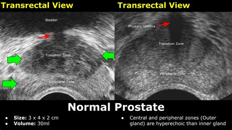 Solution Prostate Ultrasound Normal Vs Abnormal Image Appearances