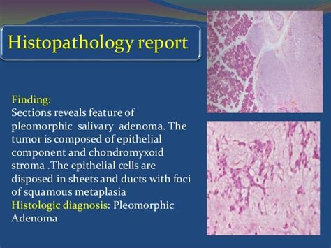 Pleomorphic Adenoma Surgical Management