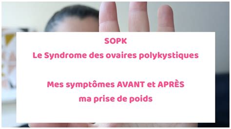 Syndrome Des Ovaires Polykystiques Sopk Mes Sympt Mes Avant Et