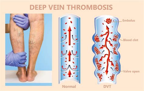 Treatment Options For Deep Vein Thrombosis Medications Surgery And More