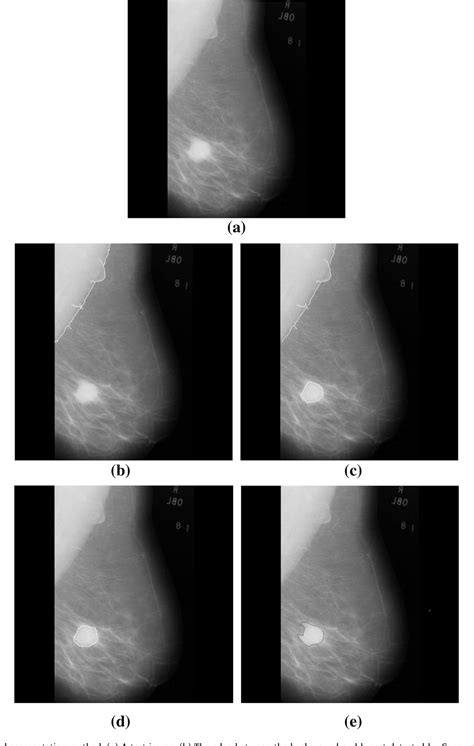 Figure 1 From Improved Watershed Transform For Tumor Segmentation