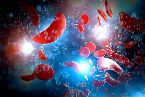 Fda Approves First Cell Based Gene Therapies For Sickle Cell Disease