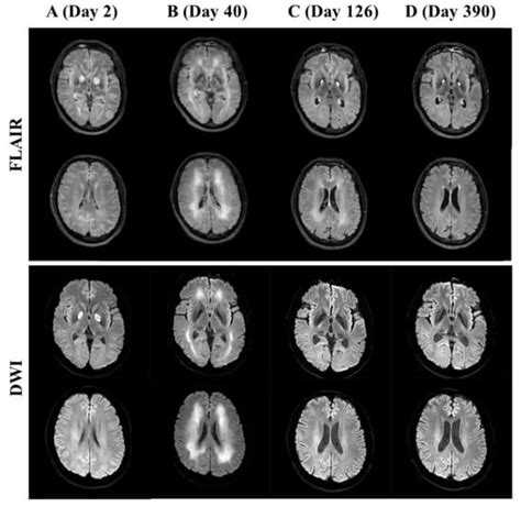 Brain Sciences Free Full Text Amantadine Improves Delayed