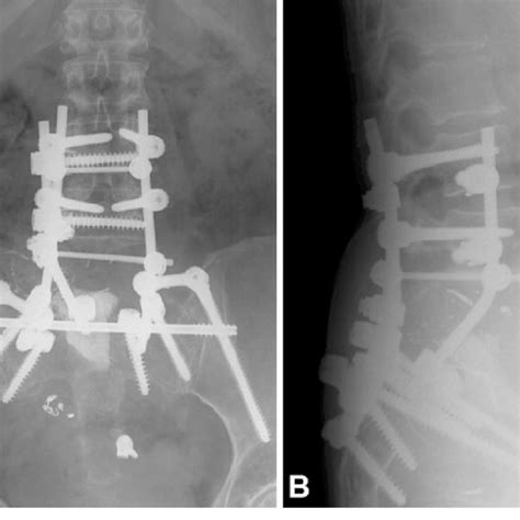 Postoperative Anteroposterior A And Lateral B Radiographs Following