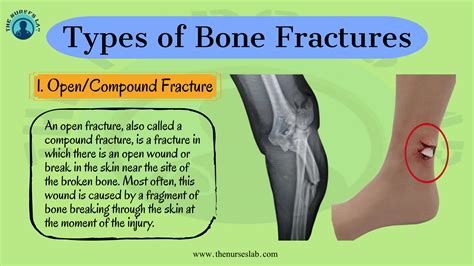 Types Of Bone Fracture