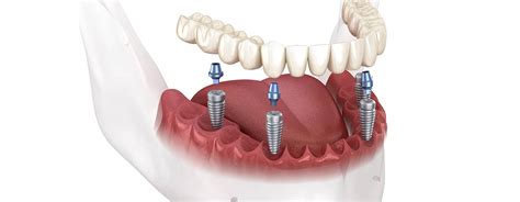 Step-by-step procedure for All-on-4 dental implants