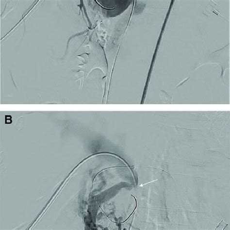 A Common Hepatic Arteriography Showing Gda Pseudoaneurysm Asterisk Download Scientific