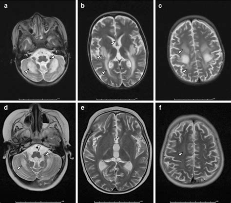 Axial T2 Weighted Brain Mr Imaging Demonstrating Differential Download Scientific Diagram