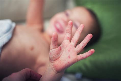 Hand Mund Fuß Krankheit und Mundfäule Das solltest du wissen