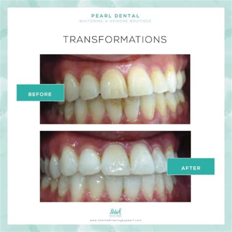 Gallery - Teeth Whitening Vancouver - Laser Teeth Whitening | Pearl ...