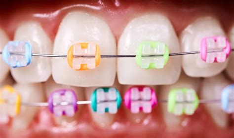 Braces Colors Combinations